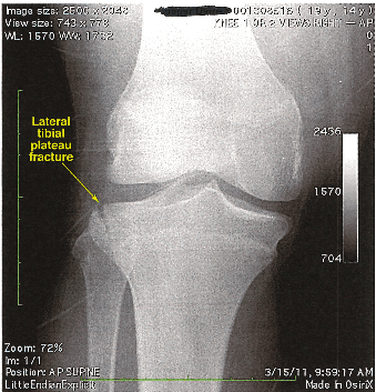 Bone Fracture Compensation